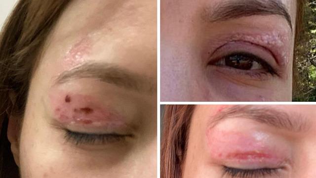 Güzellik salonunda 1000 liralık işlem yaptırdı: Gözünde kalıcı hasar oluştu!