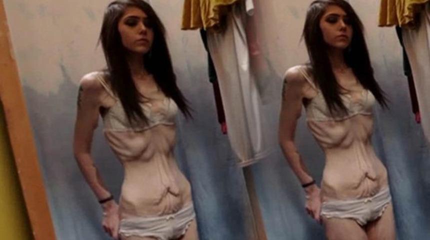 Kontrol&uuml; kaybetti, hızla kilo verirken bu hale geldi!