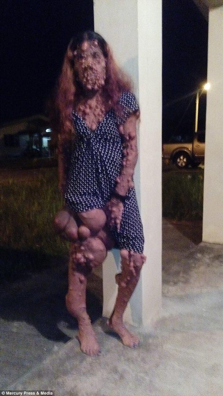 Hastalığı yüzünden tanınmaz hale geldi! Sadece kafasında 3 binden fazla tümör var G5