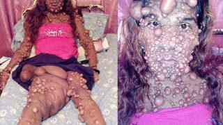 Hastalığı yüzünden tanınmaz hale geldi! Sadece kafasında 3 binden fazla tümör var