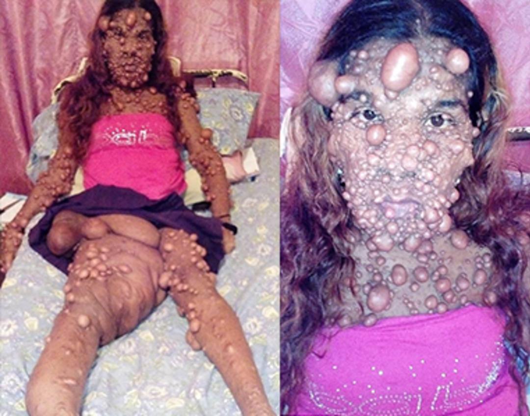 Hastalığı y&uuml;z&uuml;nden tanınmaz hale geldi! Sadece kafasında 3 binden fazla t&uuml;m&ouml;r var