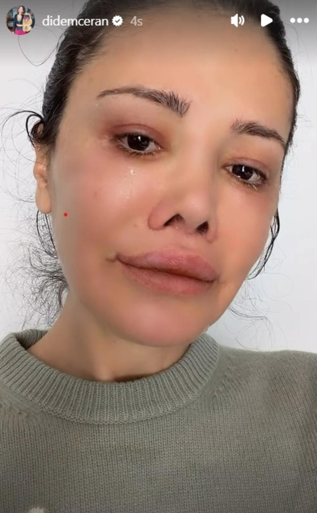 Kore de y&uuml;z nakli yaptırmıştı! Didem Ceran  Saklamak istemiyorum  diyerek hastalığını a&ccedil;ıkladı 2