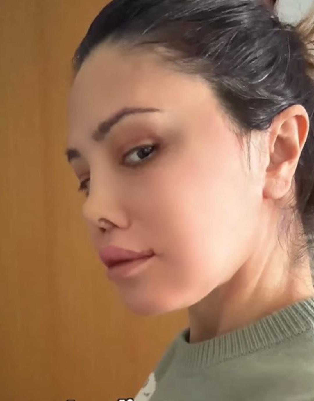 Kore de y&uuml;z nakli yaptırmıştı! Didem Ceran  Saklamak istemiyorum  diyerek hastalığını a&ccedil;ıkladı 4