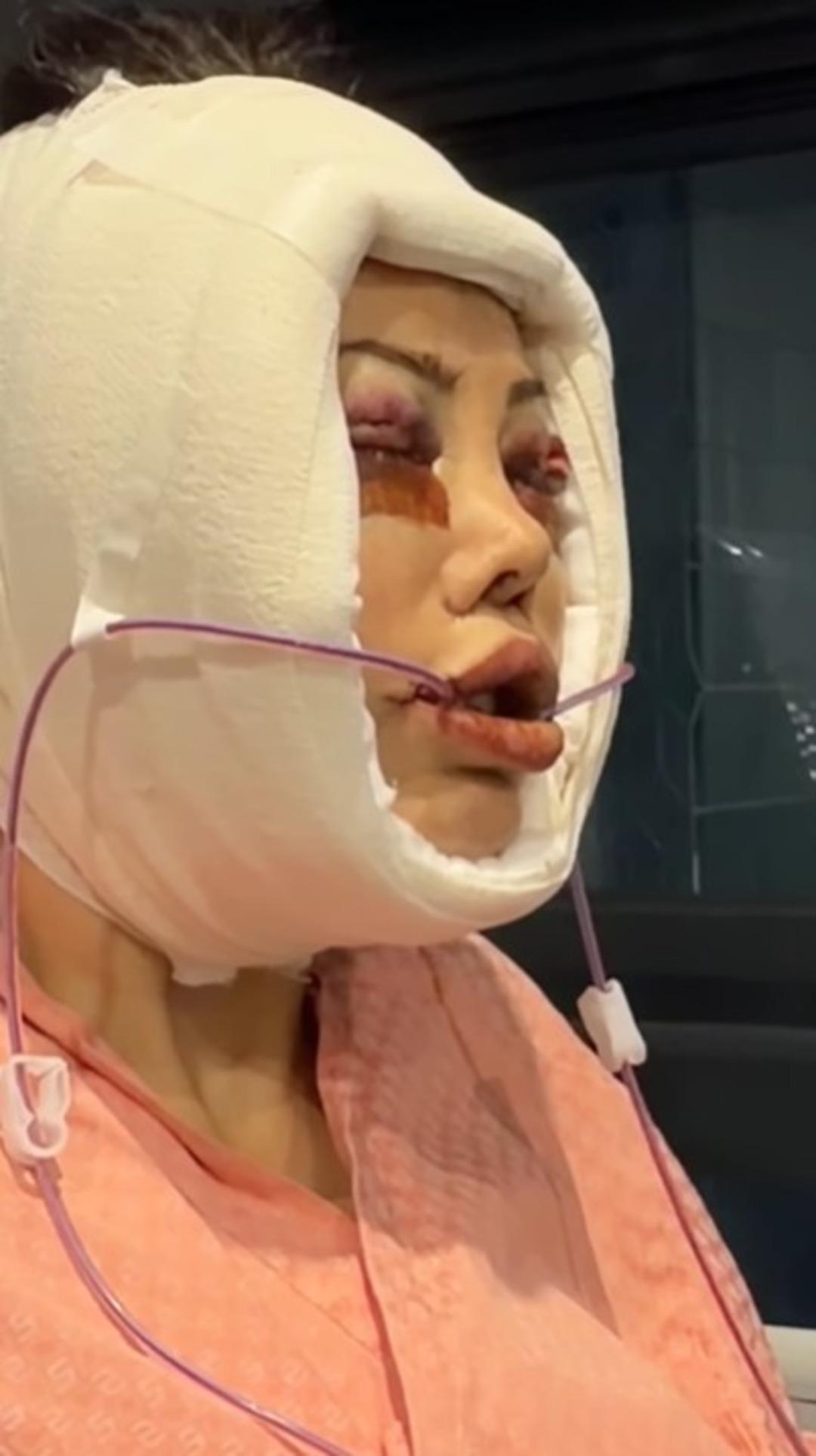 Kore de y&uuml;z nakli yaptırmıştı! Didem Ceran  Saklamak istemiyorum  diyerek hastalığını a&ccedil;ıkladı 3