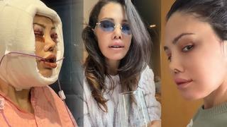 Son dakika: Y&uuml;z naklinin ardından revizyon ameliyatı olmuştu! Didem Ceran son haliyle yine g&uuml;ndemde