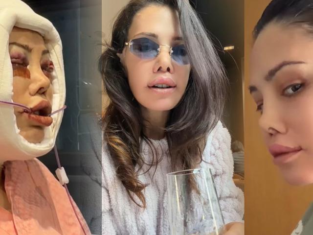 Revizyon ameliyatı olmuştu! Son hali ortaya &ccedil;ıktı 
