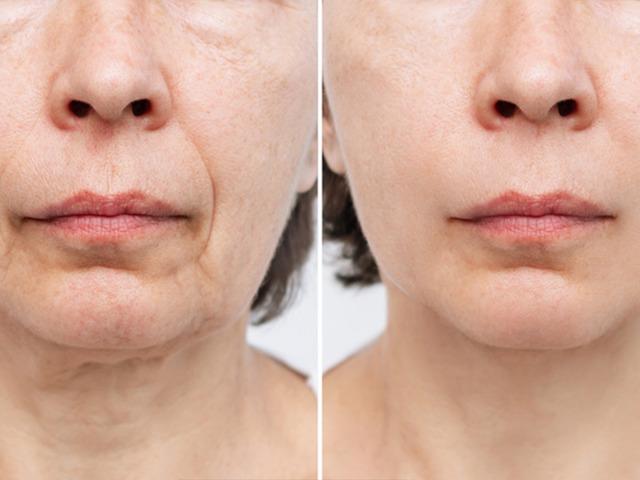 Beslenmesinden tek bir şeyi &ccedil;ıkardı 10 yaş gen&ccedil;leşti!