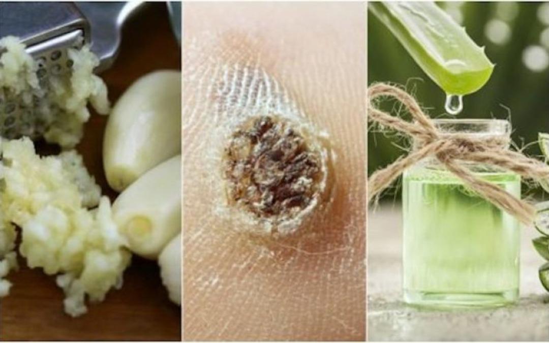 Siğil problemini k&ouml;k&uuml;nden &ccedil;&ouml;zen 4 farklı re&ccedil;ete