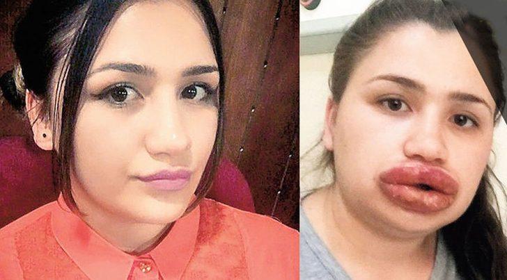 İşte silikon mağduru Merve hemşirenin son hali G3