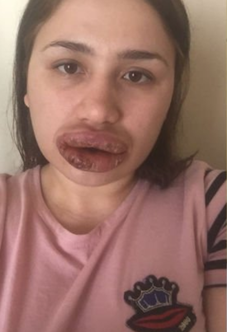 İşte silikon mağduru Merve hemşirenin son hali G5