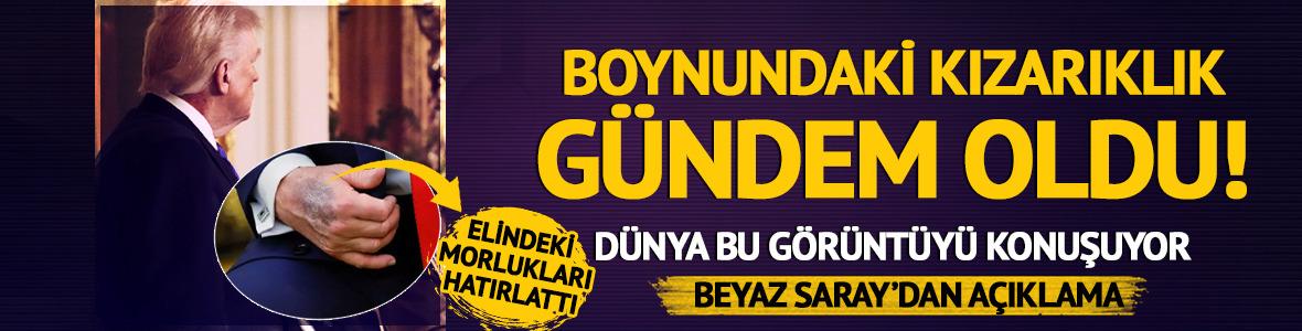 Trump'ın boynundaki morluklar g&uuml;ndem oldu!