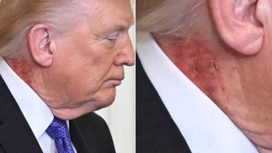 ABD Başkanı Trump ın boynundaki kızarıklık g&uuml;ndem oldu! Daha &ouml;nce ellerinde olmuştu 2