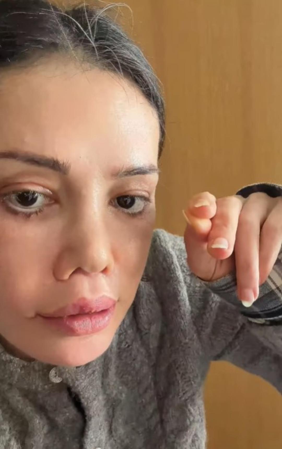 Y&uuml;z nakli yaptırmıştı! Didem Ceran ın kaşında sa&ccedil; &ccedil;ıktı! Kimse inanamadı  4