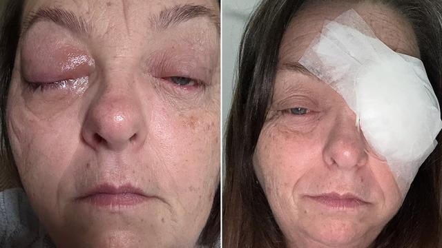 G&ouml;z&uuml;ndeki siyah noktayı sinek sandı, ger&ccedil;ek daha korkun&ccedil; &ccedil;ıktı!