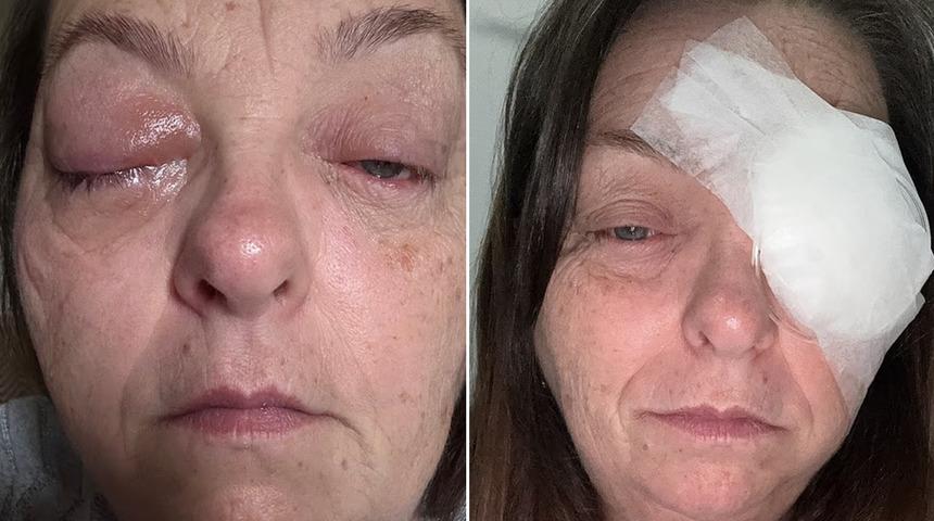 &Ccedil;ay yaparken fark etti: G&ouml;z&uuml;ndeki siyah noktayı sinek sandı, ger&ccedil;ek daha korkun&ccedil; &ccedil;ıktı! 