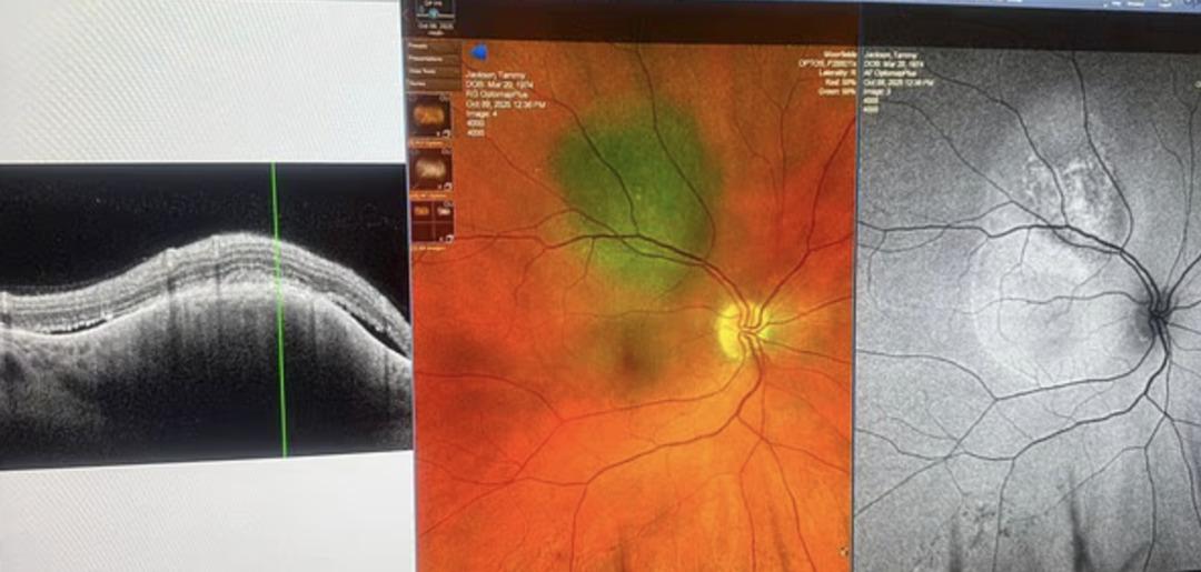 &Ccedil;ay yaparken fark etti: G&ouml;z&uuml;ndeki siyah noktayı sinek sandı, ger&ccedil;ek daha korkun&ccedil; &ccedil;ıktı!  2