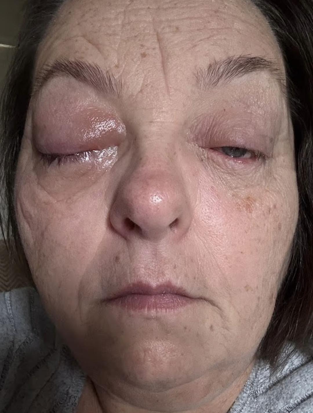 &Ccedil;ay yaparken fark etti: G&ouml;z&uuml;ndeki siyah noktayı sinek sandı, ger&ccedil;ek daha korkun&ccedil; &ccedil;ıktı!  3