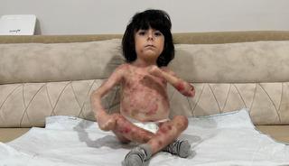 4 yaşındaki İbrahim hastalığı nedeniyle kıyafet dahi giyemiyor! 'Aile &ccedil;aresiz durumda'