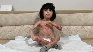 4 yaşındaki İbrahim hastalığı nedeniyle kıyafet dahi giyemiyor! 'Aile çaresiz durumda'