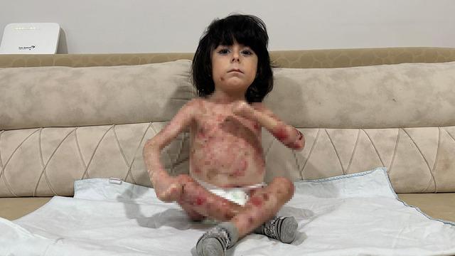 4 yaşındaki İbrahim hastalığı nedeniyle kıyafet dahi giyemiyor! 'Aile çaresiz durumda'