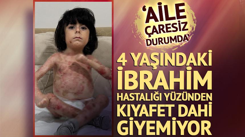 Hastalığı nedeniyle kıyafet dahi giyemiyor!