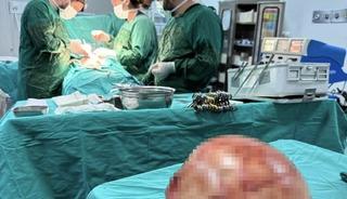 Karın ağrısı şikayetiyle gitti! Doktorlar g&ouml;zlerine inanamadı: Tam 35 santimetre