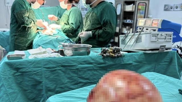 Karın ağrısı şikayetiyle gitti! Doktorlar g&ouml;zlerine inanamadı: Tam 35 santimetre