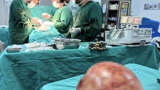 Karın ağrısı şikayetiyle gitti! Doktorlar gözlerine inanamadı: Tam 35 santimetre