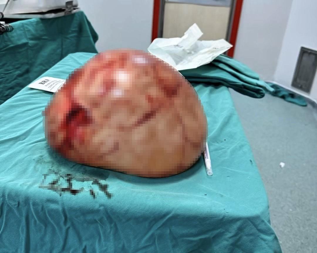 Karın ağrısı şikayetiyle gitti! Doktorlar g&ouml;zlerine inanamadı: Tam 35 santimetre 1