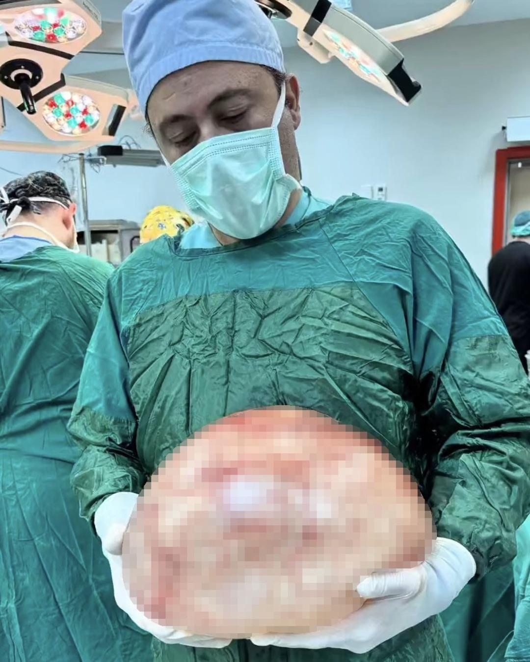 Karın ağrısı şikayetiyle gitti: 35 santimetrelik dev kitle &ccedil;ıkarıldı 1