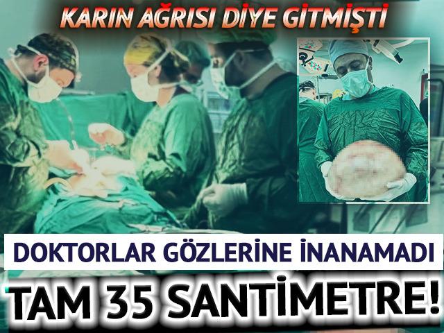 Karın ağrısı şikayetiyle gitti! Doktorlar g&ouml;zlerine inanamadı: Tam 35 santimetre
