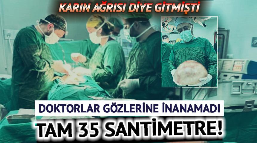 Karın ağrısı şikayetiyle gitti! Doktorlar g&ouml;zlerine inanamadı: Tam 35 santimetre
