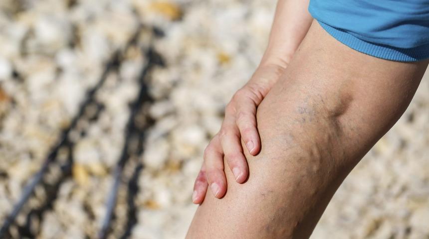 Buerger hastalığı nedir? Kangren tedavi edilebilir mi? 