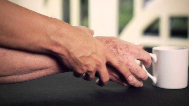 Parkinson hastalığından kurtulmak mümkün mü? Parkinson hastalığına karşı nasıl önlem alınabilir?