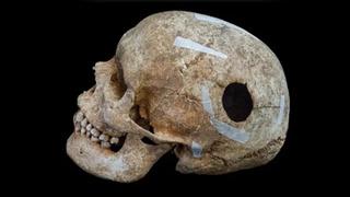 Döneminin 'dev'iydi! İlginç kafatası: 1200 yıl öncesinde yapılmış