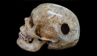 D&ouml;neminin 'dev'iydi! Kafasında 2.5 santim delik a&ccedil;mışlar