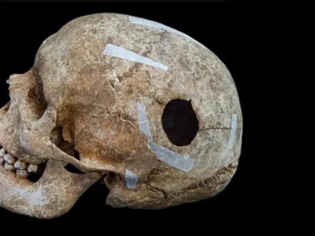 D&ouml;neminin 'dev'iydi! Kafasında 2.5 santim delik a&ccedil;mışlar