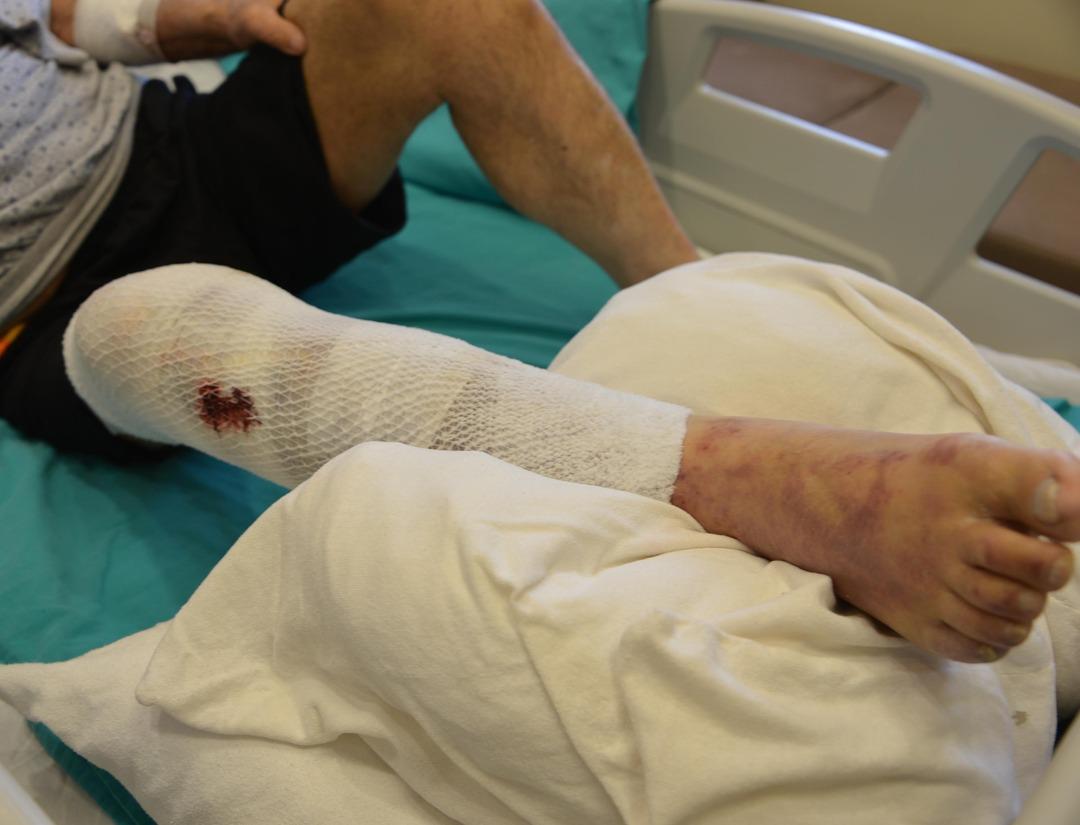 Tıkalı lavaboyu a&ccedil;maya &ccedil;alıştı, kimyasal bacağını yaktı! 1