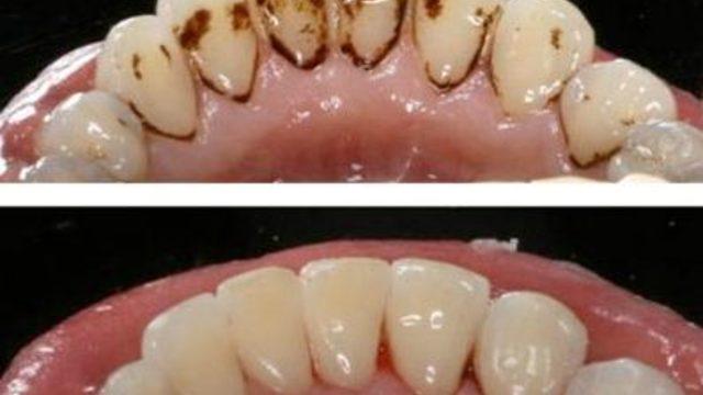 Diş tartarı nasıl temizlenir? Kanıtlanmış 10 yöntem