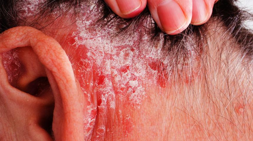 Yeterli güneş alınmadığında vücutta neler oluyor?