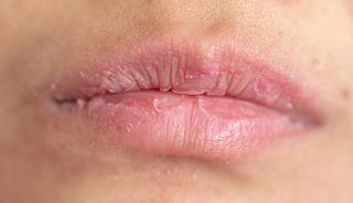 S&uuml;rekli dudak yiyenler dikkat! Sebebi d&uuml;ş&uuml;nd&uuml;ğ&uuml;n&uuml;zden farklı