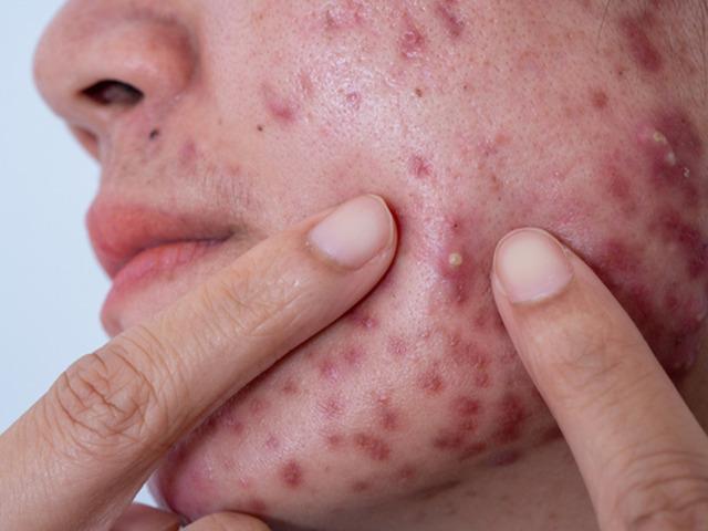 Cilt hapları zararlı mı? 'Psikolojinizden olmayın' 