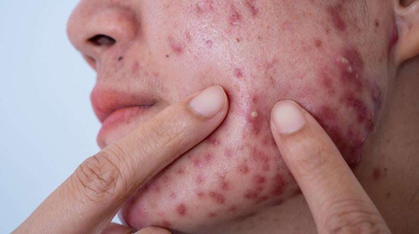 Sivilce hapları zararlı mı? Uyarı geldi: 'D&uuml;zelteyim derken psikolojinizden olmayın' 
