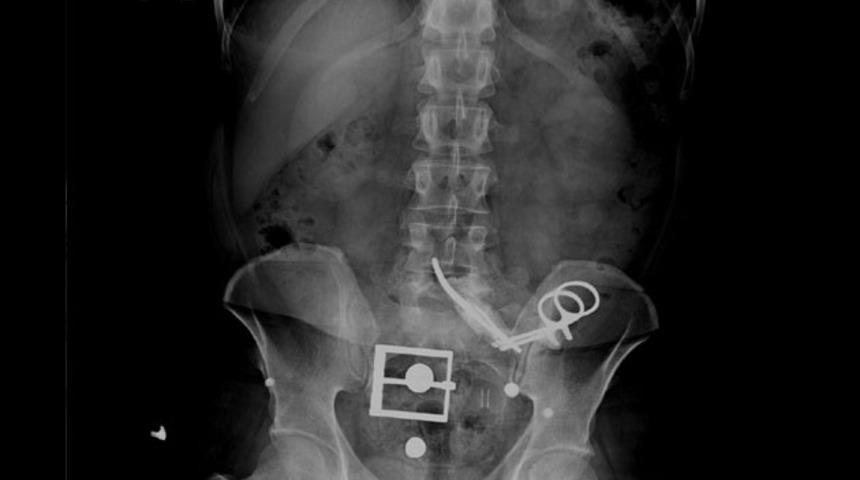 Karnında unutulan makasla 23 yıl yaşadı
