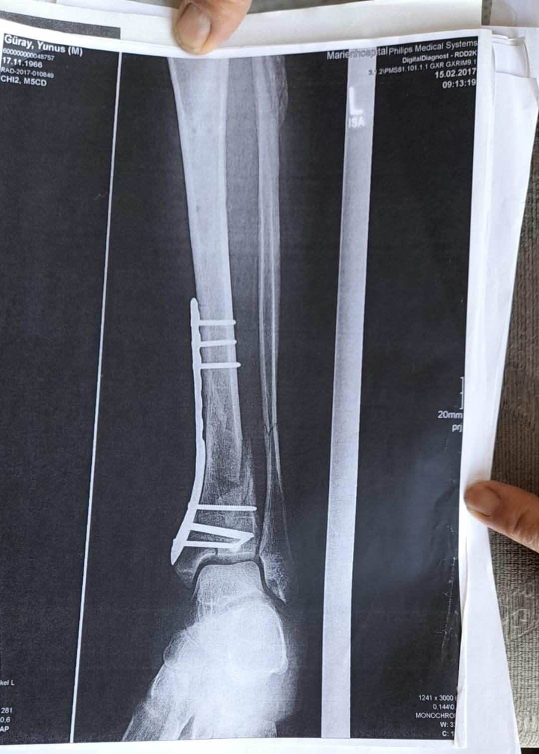 Tatili kabusa d&ouml;nd&uuml;! 2 metrelik &ccedil;ukura d&uuml;şt&uuml;: "&Ouml;mr&uuml;m&uuml; yediler, sakat bıraktılar"  2