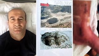 Tatili kabusa döndü! 2 metrelik çukura düştü: Ömrümü yediler, sakat bıraktılar 