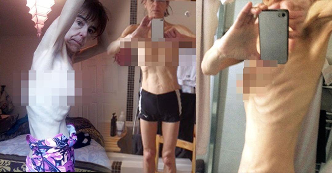 Her g&uuml;n biraz daha k&uuml;&ccedil;&uuml;l&uuml;yor! Anoreksiyadan kurtulmak i&ccedil;in &ccedil;abalıyor