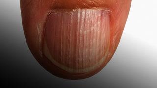 Protein eksikliği olduğunu gösteren işaretler