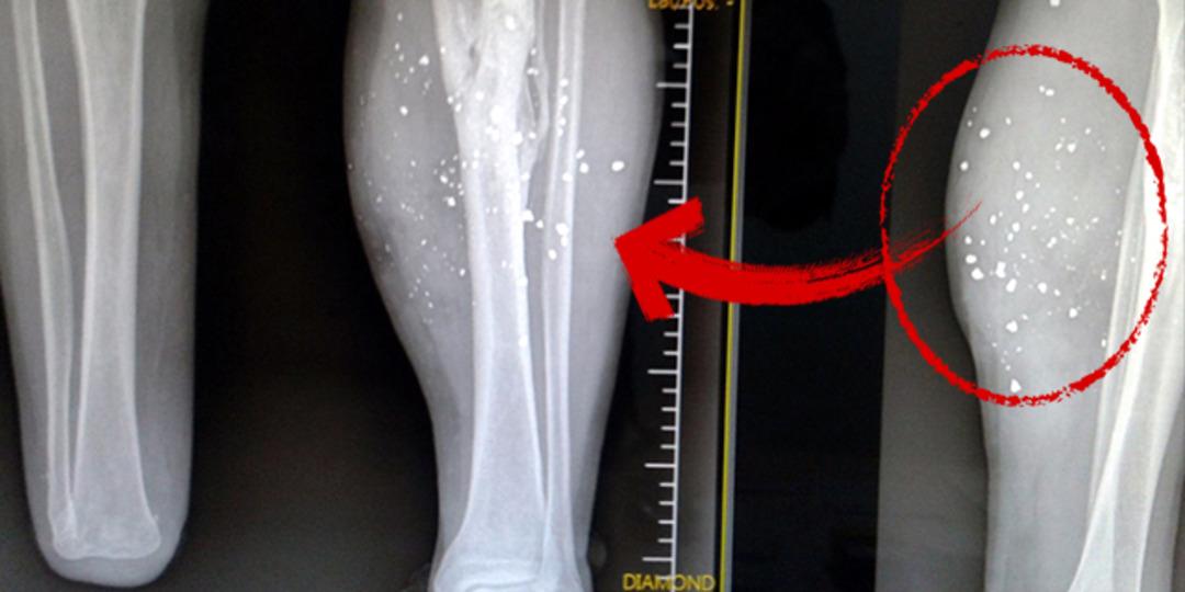 24 yıldır bedeninde şarapnel par&ccedil;alarıyla yaşıyor