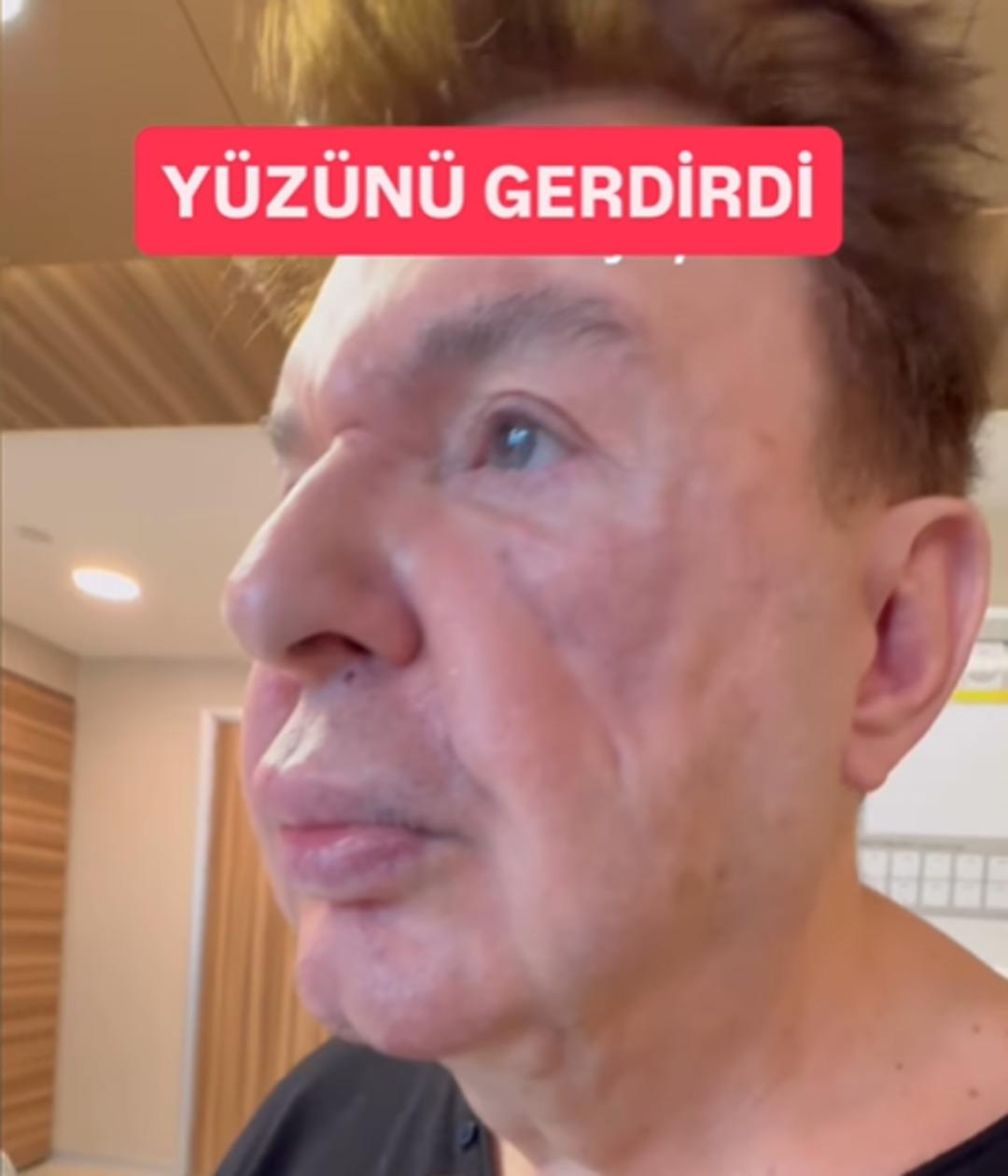 Dolgular sonrası y&uuml;z&uuml; deforme oldu! Kuşum Aydın ın filtresiz g&ouml;r&uuml;n&uuml;m&uuml;... 1